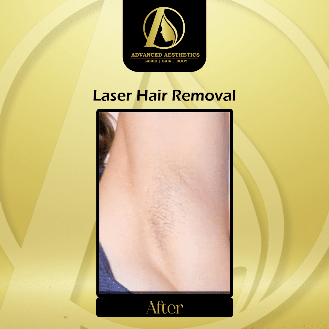 Laser Hair Removal Advanced Aesthetic Specialist